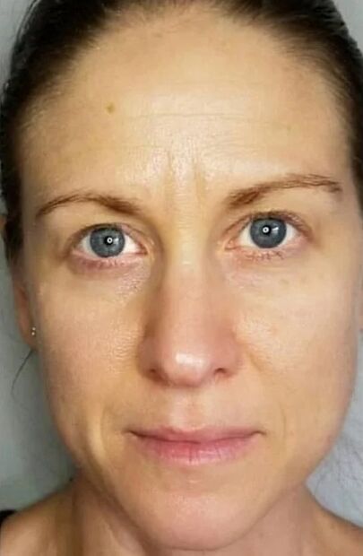Simpla 360 a aidé à rajeunir la peau et à éclaircir les taches
